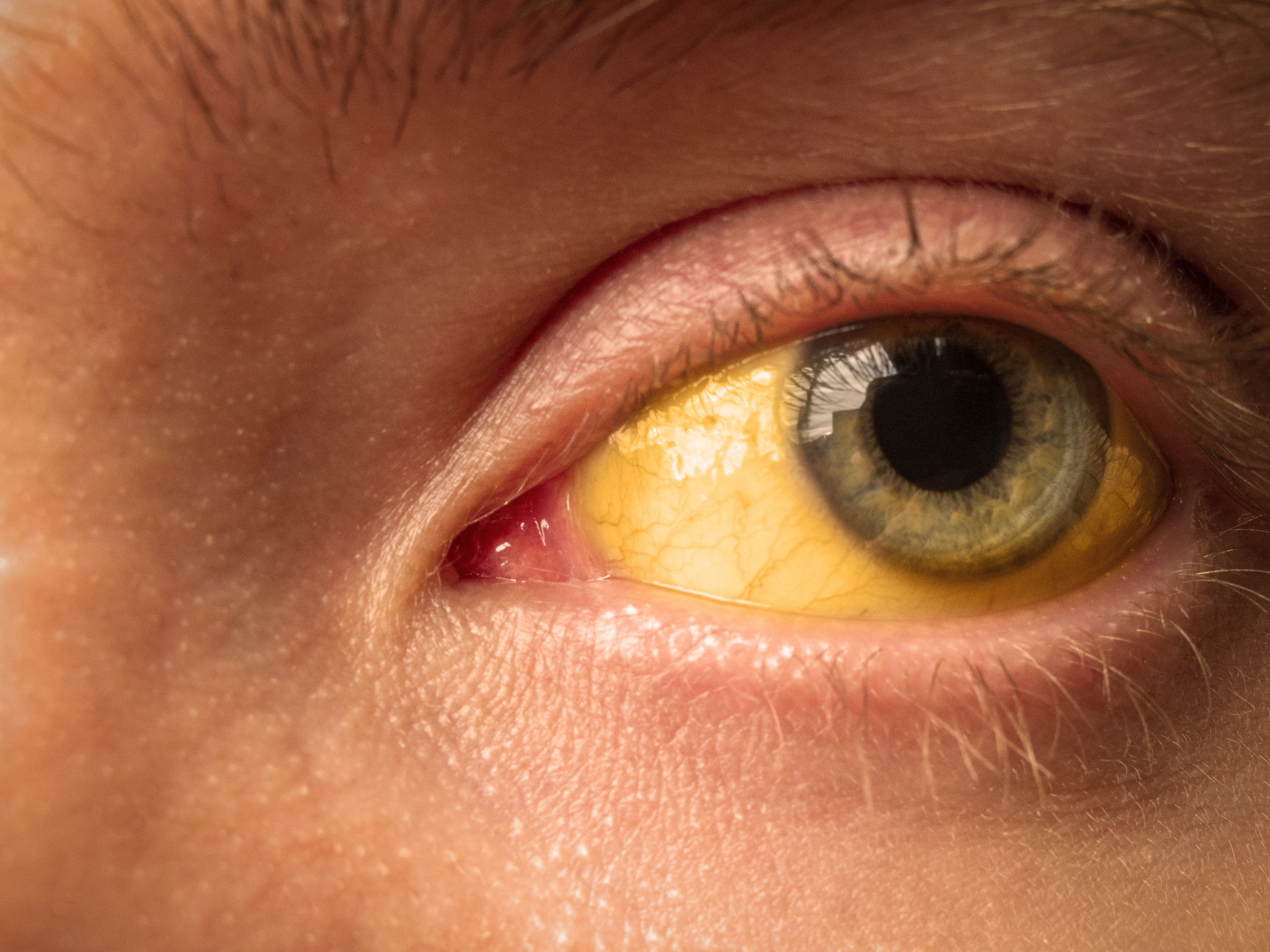 De klachten van Hepatitis A beginnen vaak met vermoeidheid, milde koorts, misselijkheid, verminderde eetlust en een zeurende pijn rechts in de bovenbuik, ter hoogte van de lever. Na enkele dagen kan geelzucht optreden, waarbij de huid en het oogwit geel verkleuren.