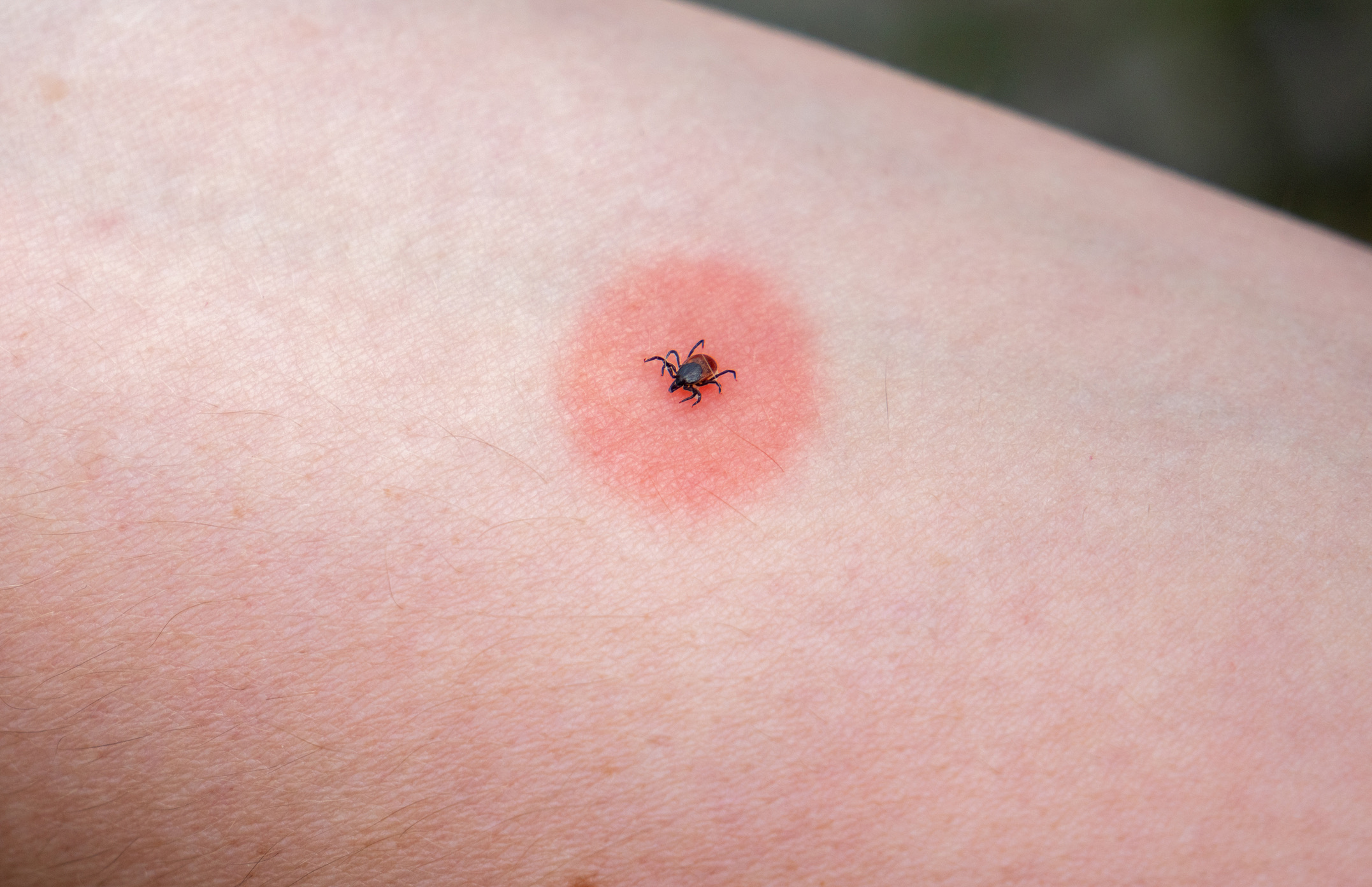 het bekendste vroege teken van de ziekte van Lyme is een uitbreidende, rode ring of vlek op de plek van de beet (erythema migrans), die vaak binnen drie tot dertig dagen verschijnt. 