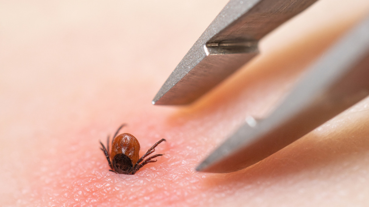 Teek die vast zit in huid wordt verwijderd met een pincet
