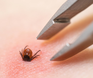 Teek die vast zit in huid wordt verwijderd met een pincet