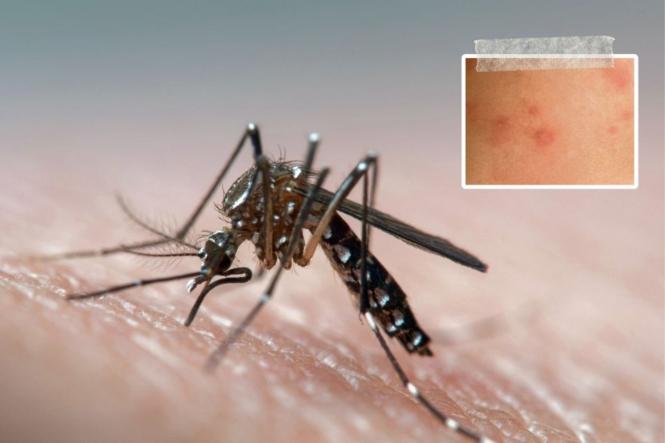 Zo voorkom, herken en behandel je een muggenbeet. Foto: Getty Images