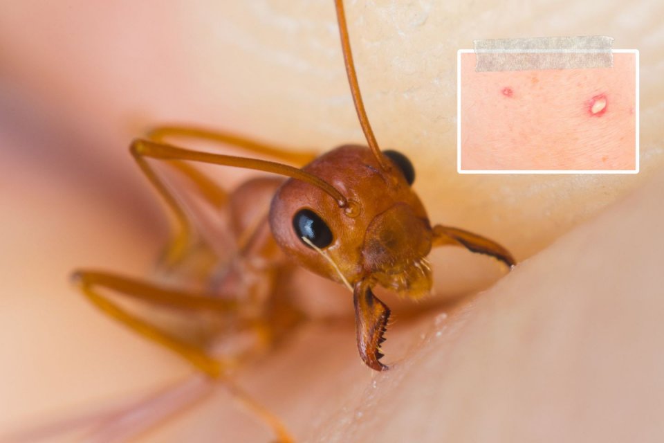 Zo voorkom, herken en behandel je een mierenbeet. Foto: Getty Images