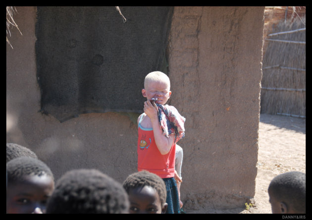 Albino in Malawi